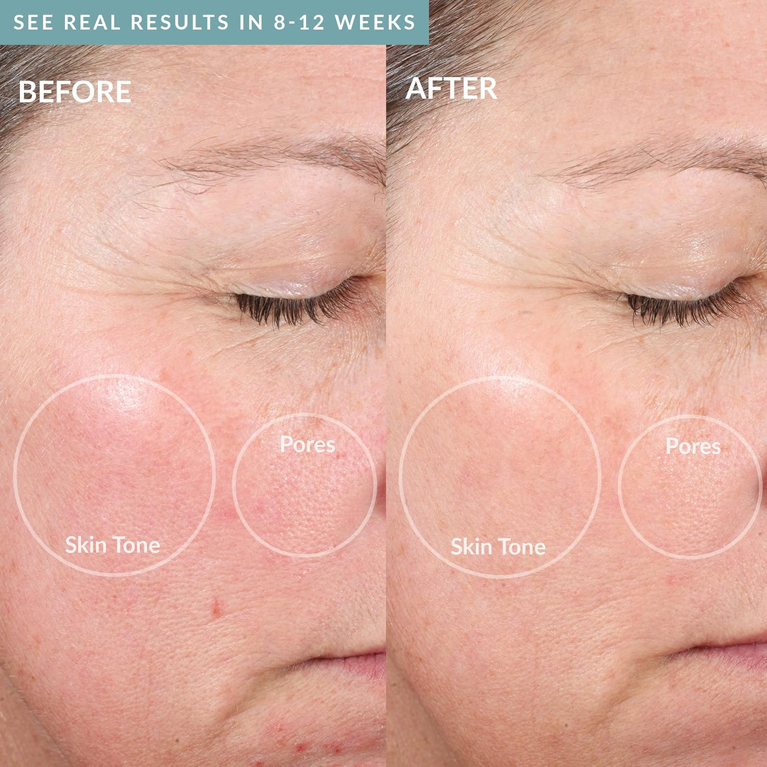 PMD Microderm Elite Pro Sky 2