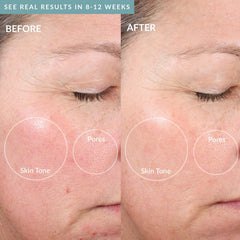 PMD Microderm Elite Pro Sky 2