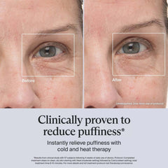 Close-up before and after showing clinically proven under-eye puffiness reduction using Therabody TheraFace Pro cold and heat therapy