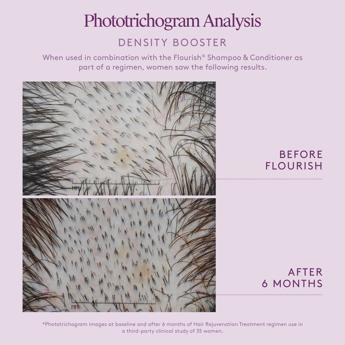 Phototrichogram scalp close-ups showing denser hair after 6 months of the Virtue Flourish Density Booster regimen