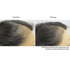 Before and after comparison of hair density on a person's head, labeled 'Baseline' and '90 Days'.
