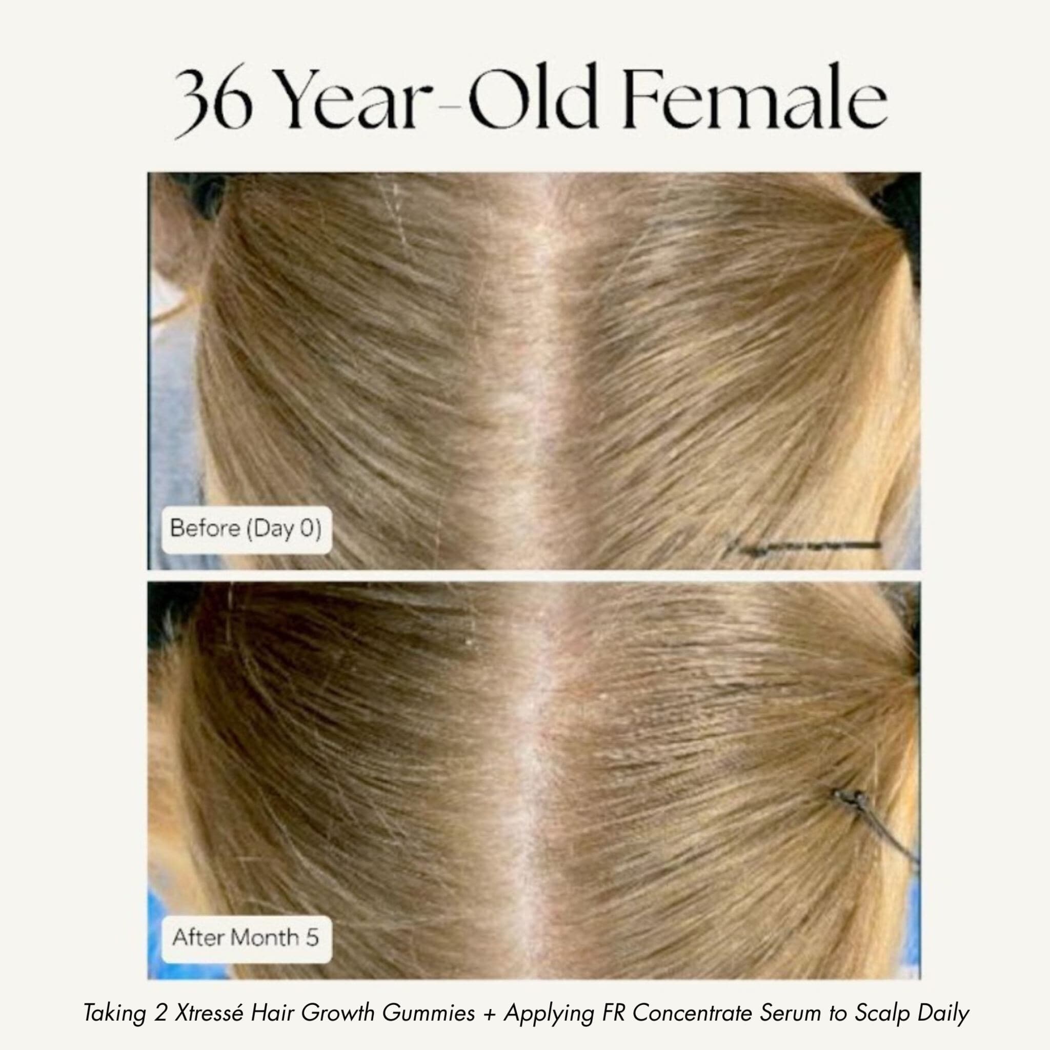 Xtressé hair growth results 36 year old before and after 5 months scalp coverage