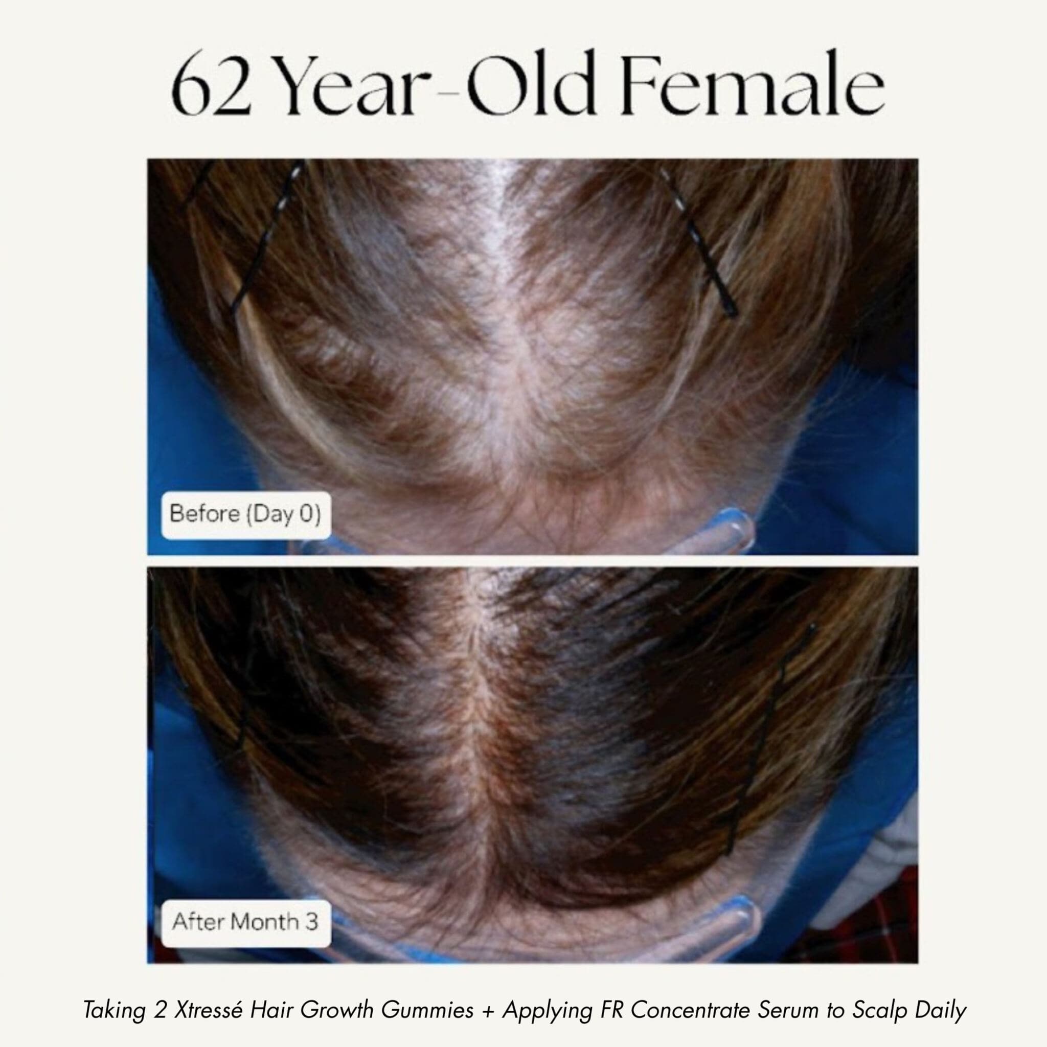 Xtressé hair growth results 62 year old before and after 3 months scalp coverage