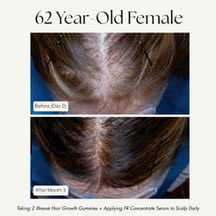 Xtressé hair growth results 62 year old before and after 3 months scalp coverage