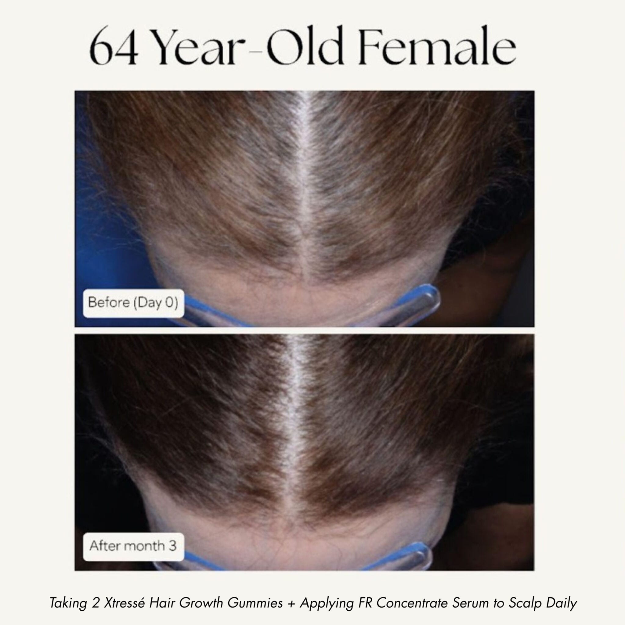 Xtressé hair growth results 64 year old before and after 6 months hairline density