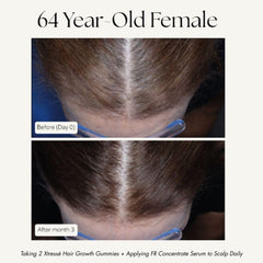 Xtressé hair growth results 64 year old before and after 6 months hairline density