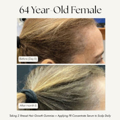 Xtressé hair growth results 64 year old before and after 3 months part width
