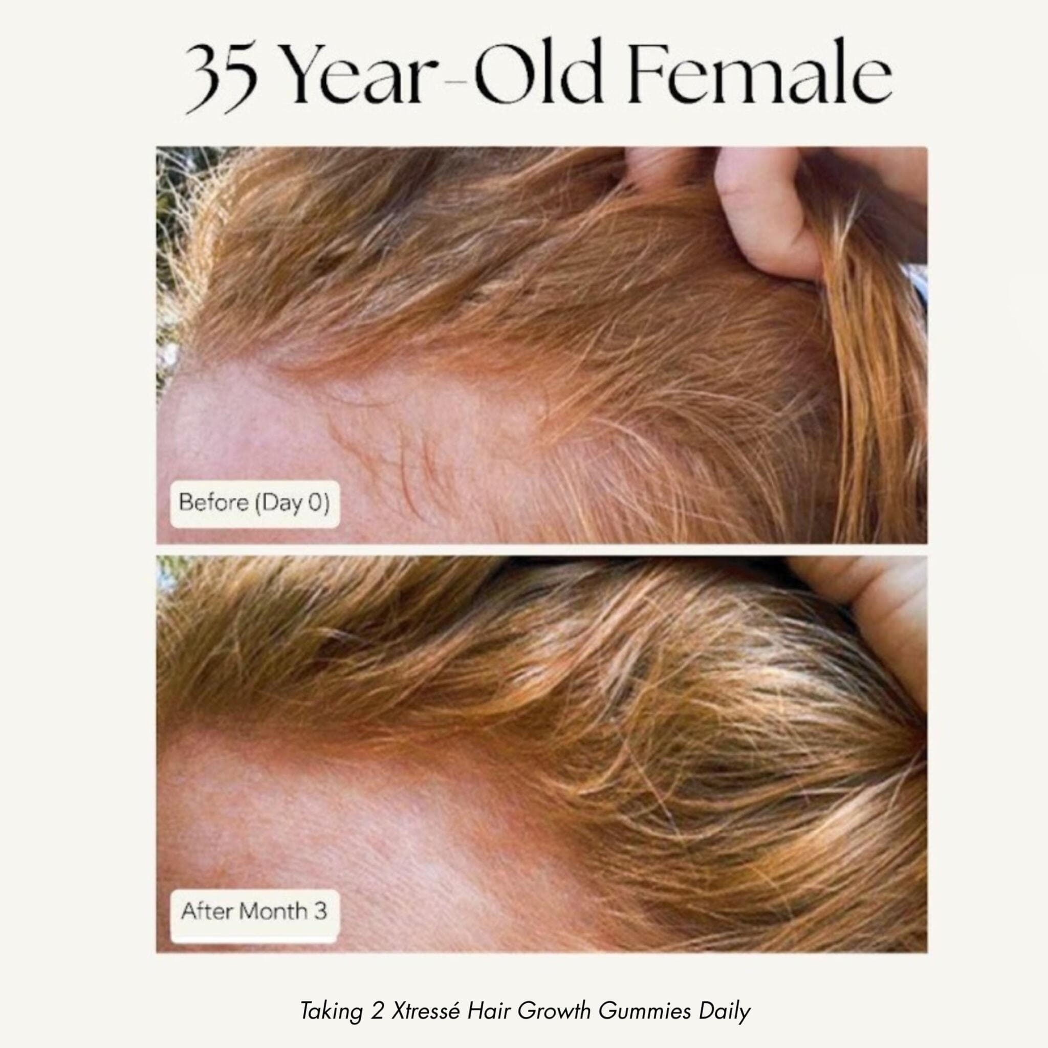 Xtresse hair growth results 35 year old before and after 3 months hairline density