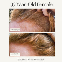 Xtresse hair growth results 35 year old before and after 3 months hairline density