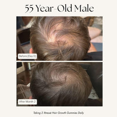 Xtresse hair growth results 55 year old male before and after 2 months crown coverage