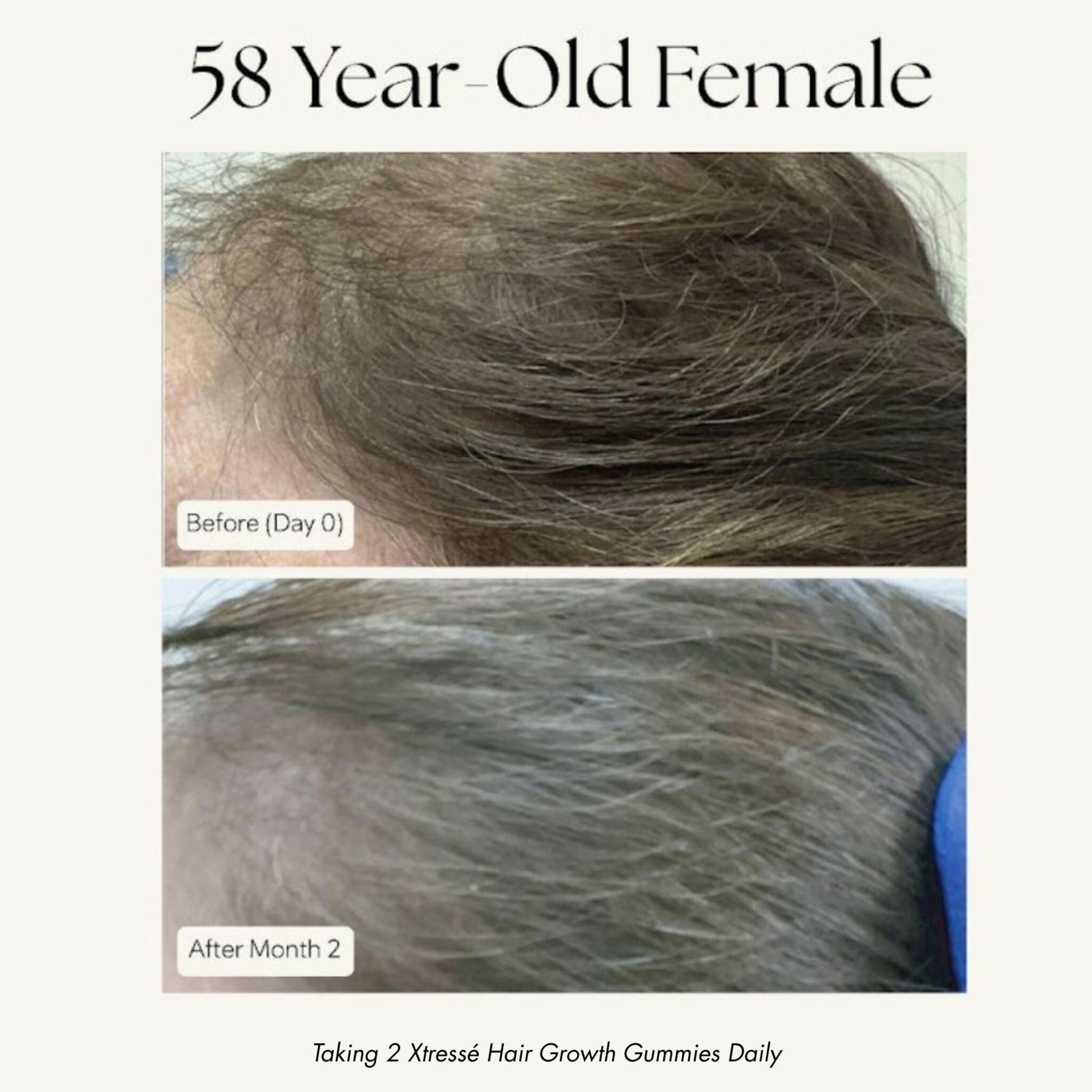 Xtresse hair growth results 58 year old before and after 2 months hairline density