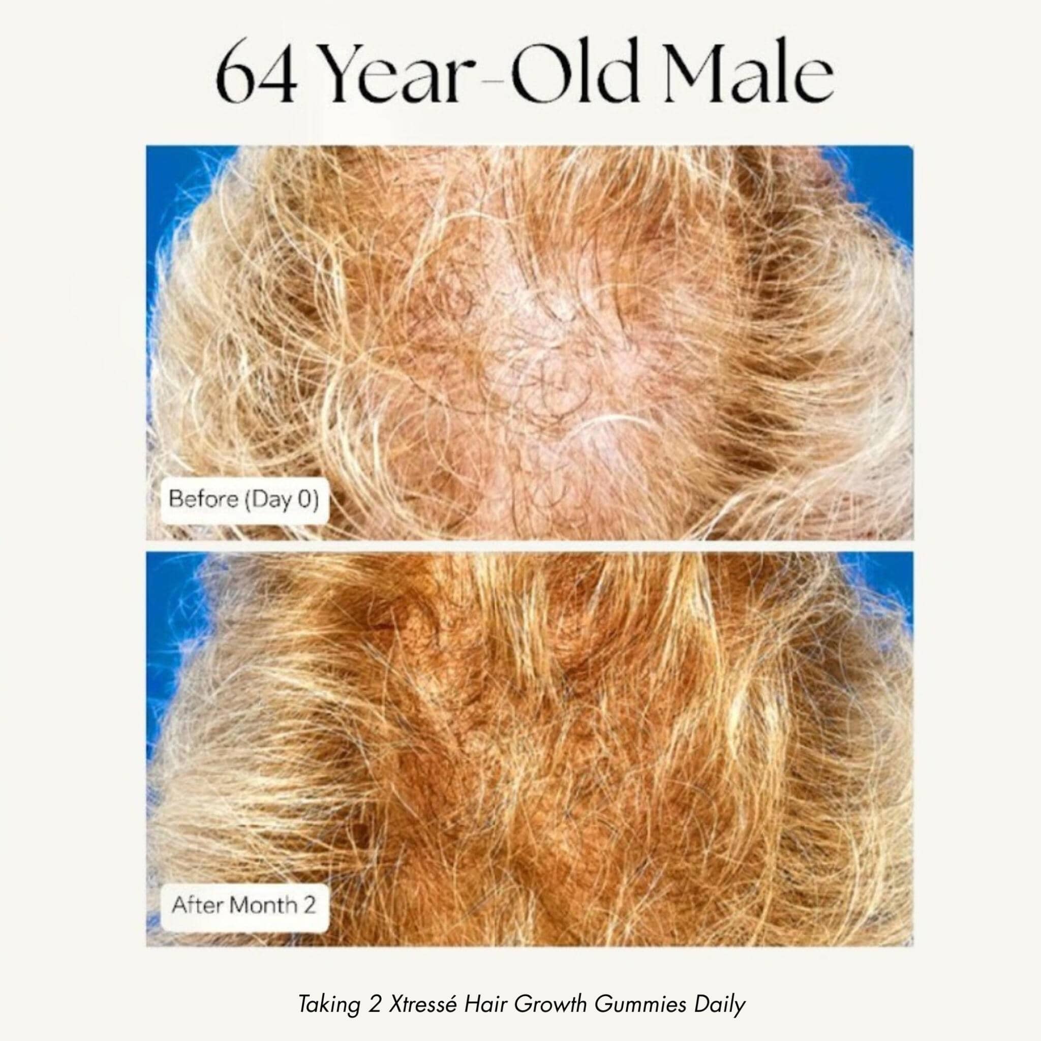 Xtresse hair growth results 64 year old male before and after 2 months scalp coverage