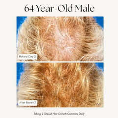 Xtresse hair growth results 64 year old male before and after 2 months scalp coverage