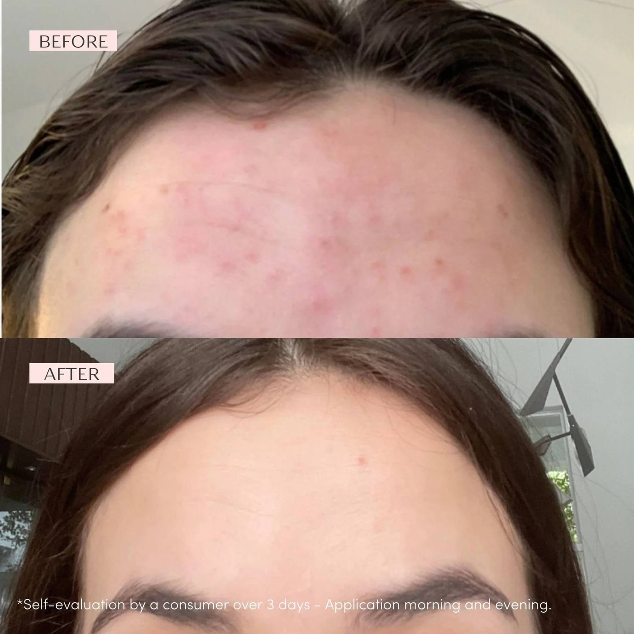Before and after using Yon-Ka SOS Spot Roll-On showing clearer skin in 3 days