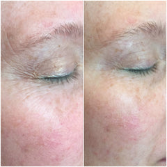 CO2Lift® Pro Carboxy Gel Treatment Skin Care Masks & Peels Before and After Eyes Shop at Exclusive Beauty