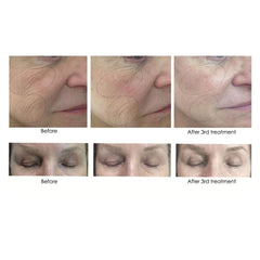 CO2Lift® Pro Carboxy Gel Treatment Skin Care Masks & Peels Before and Afters Shop at Exclusive Beauty