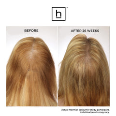 Hairmax Laser Band 41 ComfortFlex Hair Growth Device Hair Loss Treatments Hairmax Shop at Exclusive Beauty