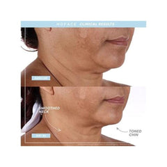 NuFACE TRINITY+ PRO Starter Kit NuFACE Shop at Exclusive Beauty