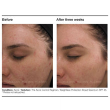 Load image into Gallery viewer, PCA Skin Acne Control Regimen PCA Skin Shop at Exclusive Beauty Club
