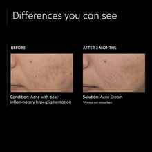 Carregar imagem no visualizador da Galeria, PCA Skin Acne Cream PCA Skin Shop at Exclusive Beauty Club
