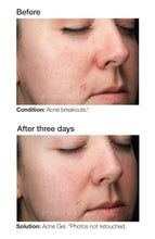 Carregar imagem no visualizador da Galeria, PCA Skin Acne Gel New and Improved Formula PCA Skin Shop at Exclusive Beauty Club
