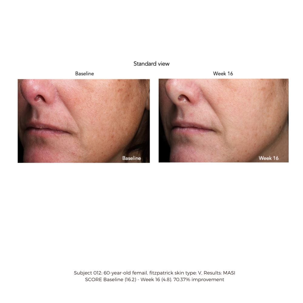 Sente Cysteamine HSA Pigment & Tone Corrector SENTE Shop at Exclusive Beauty